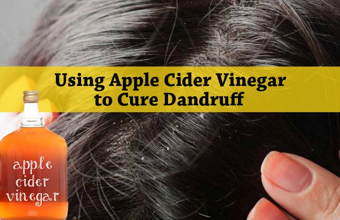 Apple Cider Vinegar For Rid of Dandruff