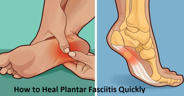 fastest way to cure plantar fasciitis